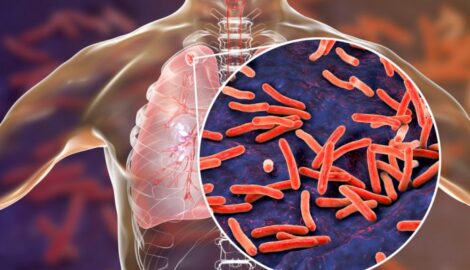 В Ульяновской области наблюдается увеличение случаев заболевания туберкулезом и ВИЧ